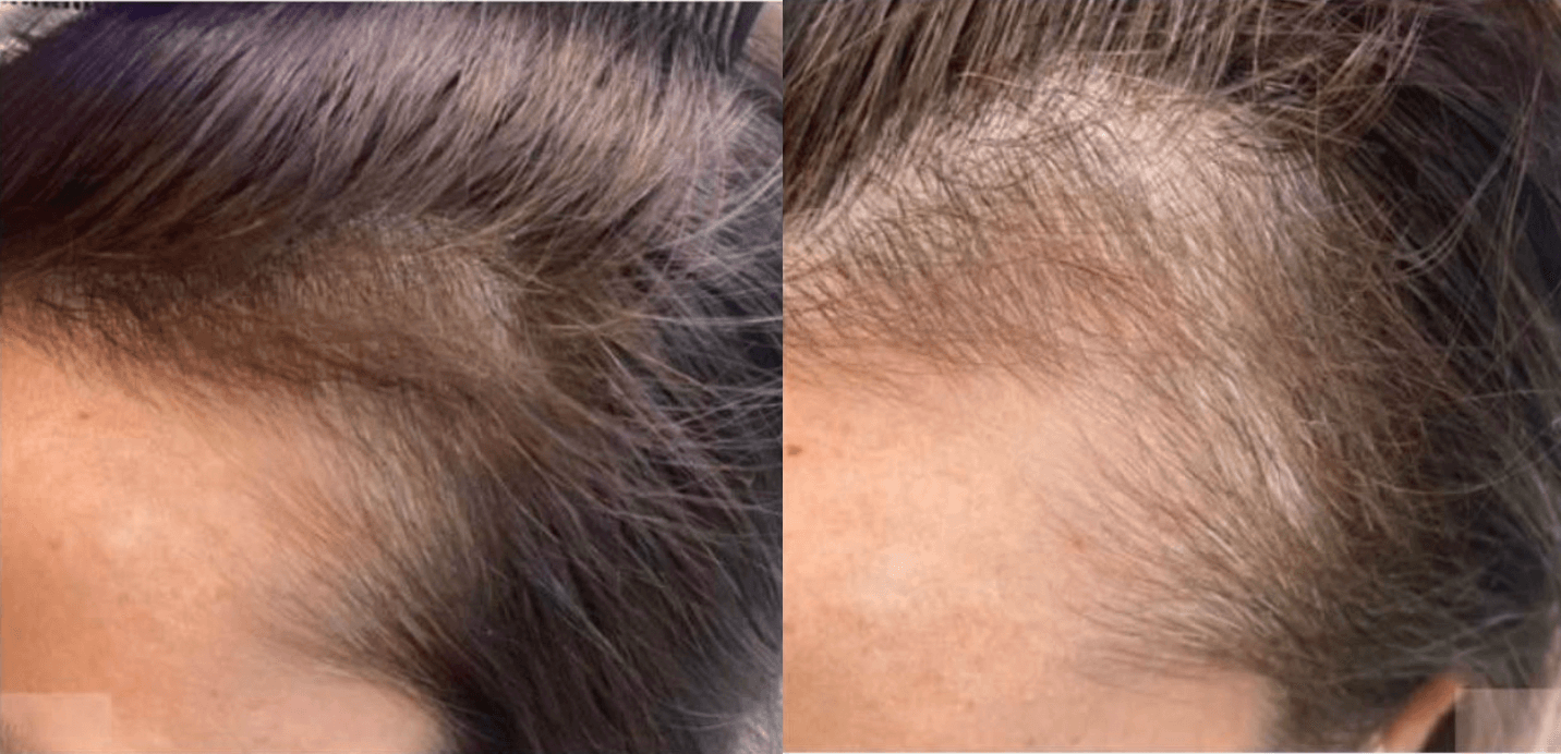 Example of Exosomes effect