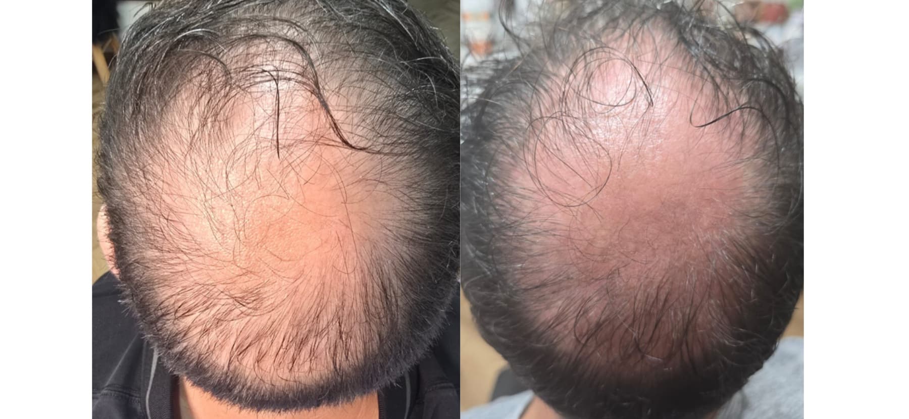 Example of Exosomes effect