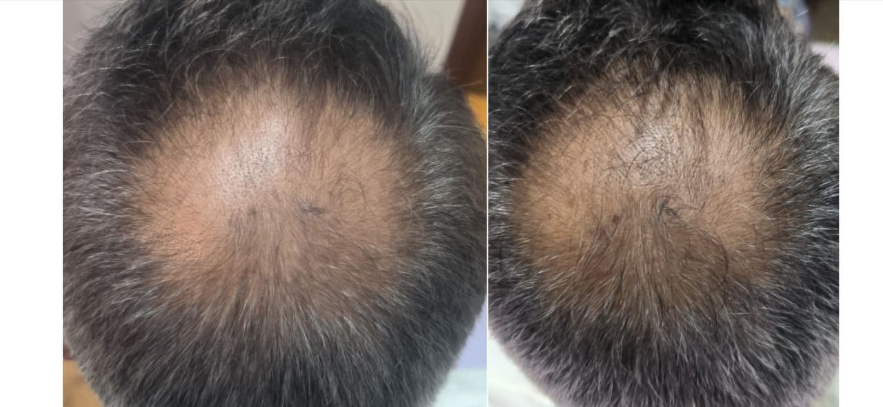 Example of Exosomes effect