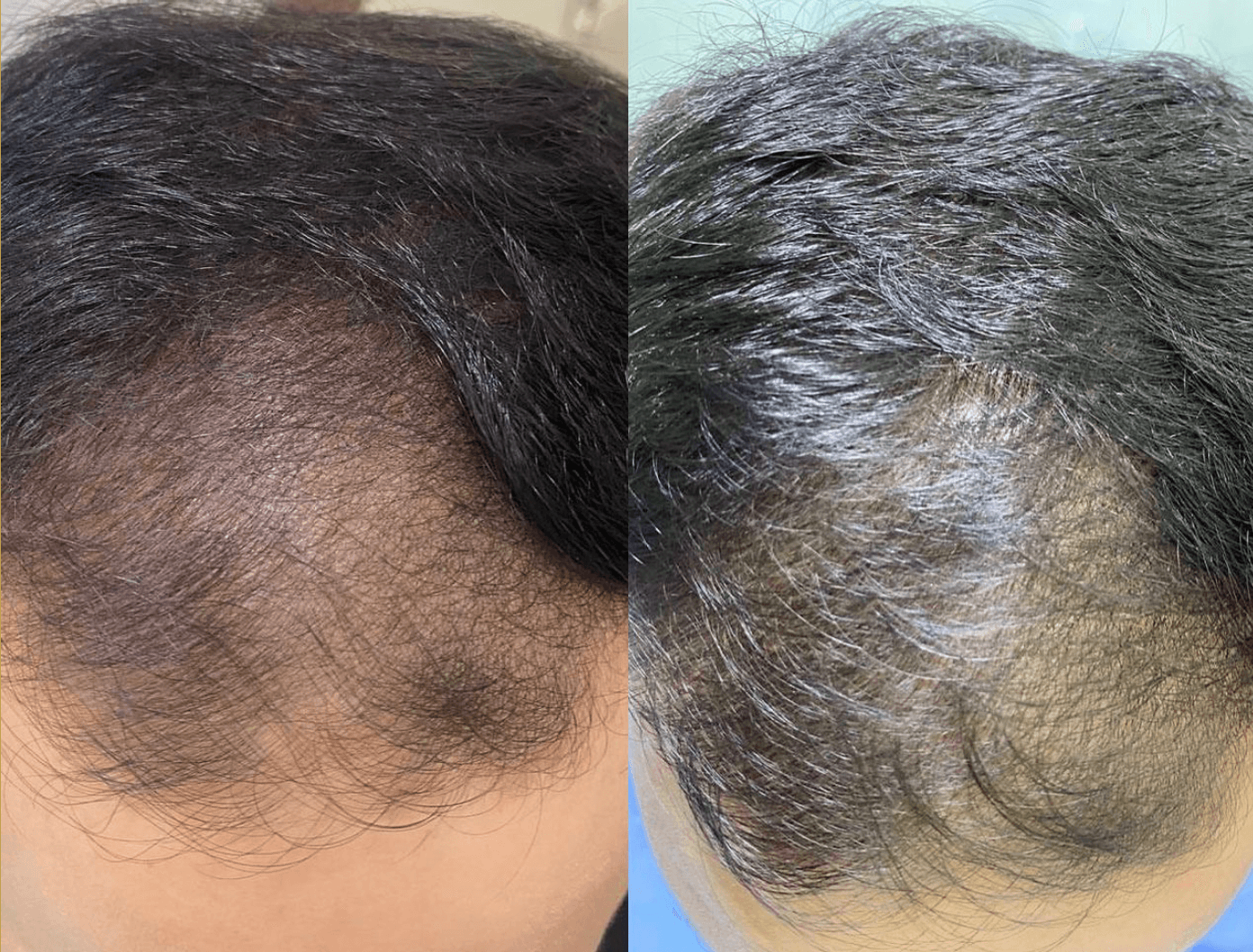 Example of Exosomes effect