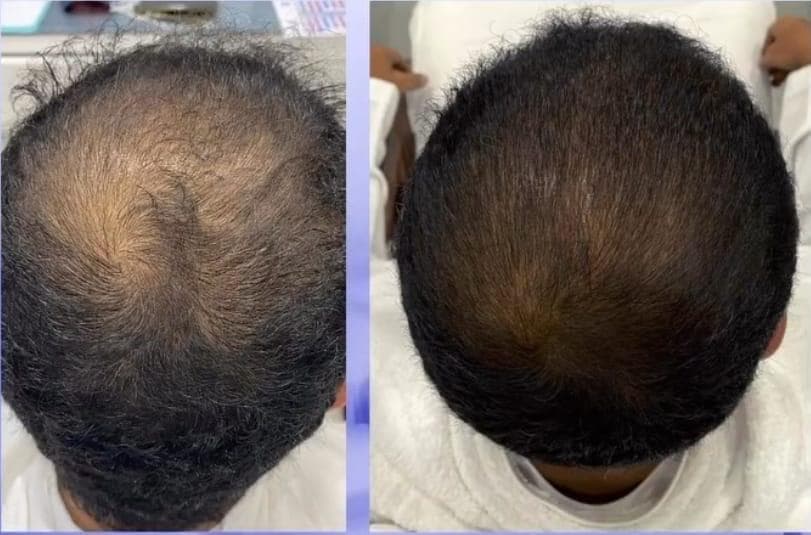 Example of Exosomes effect