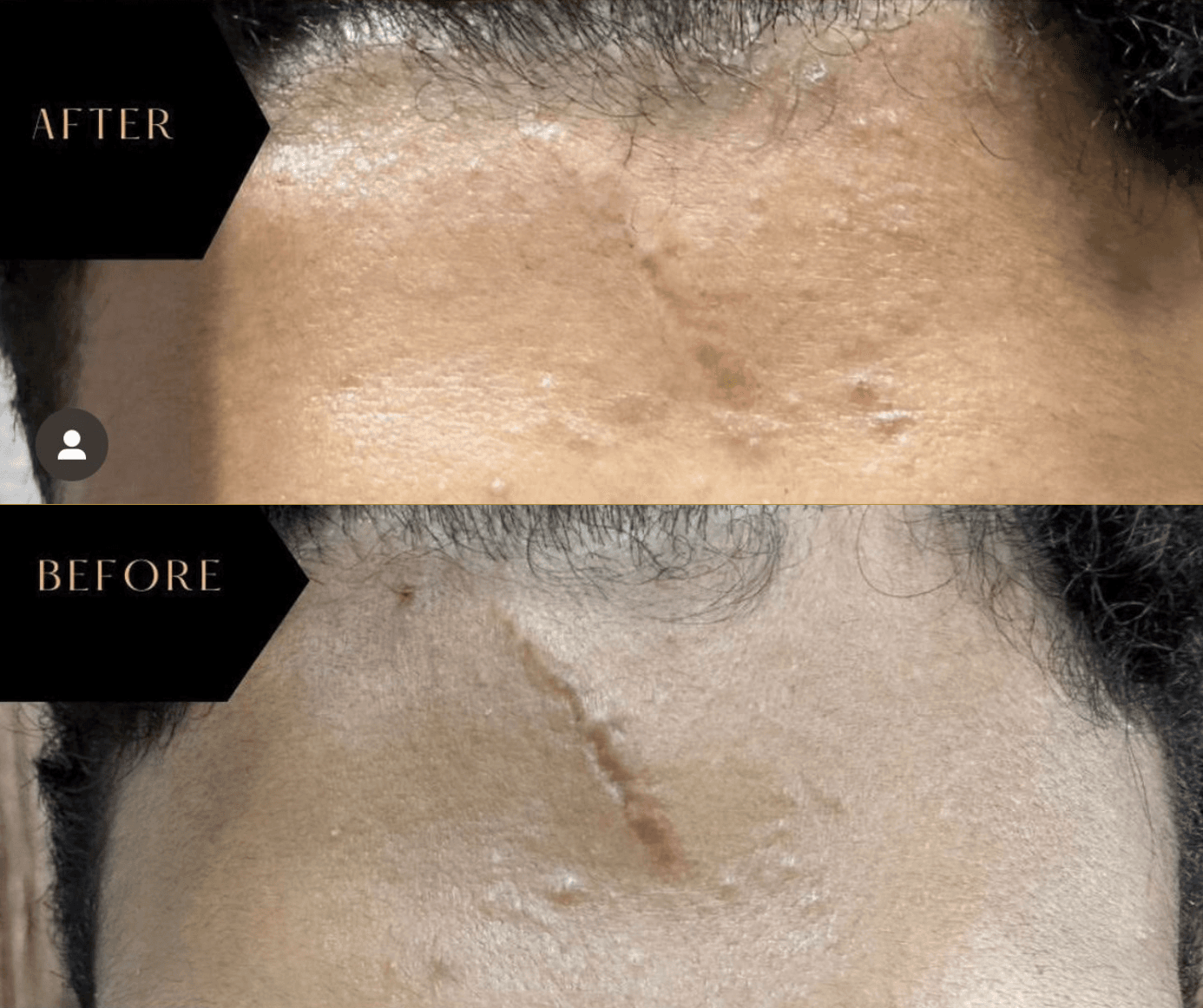 Example of Exosomes effect