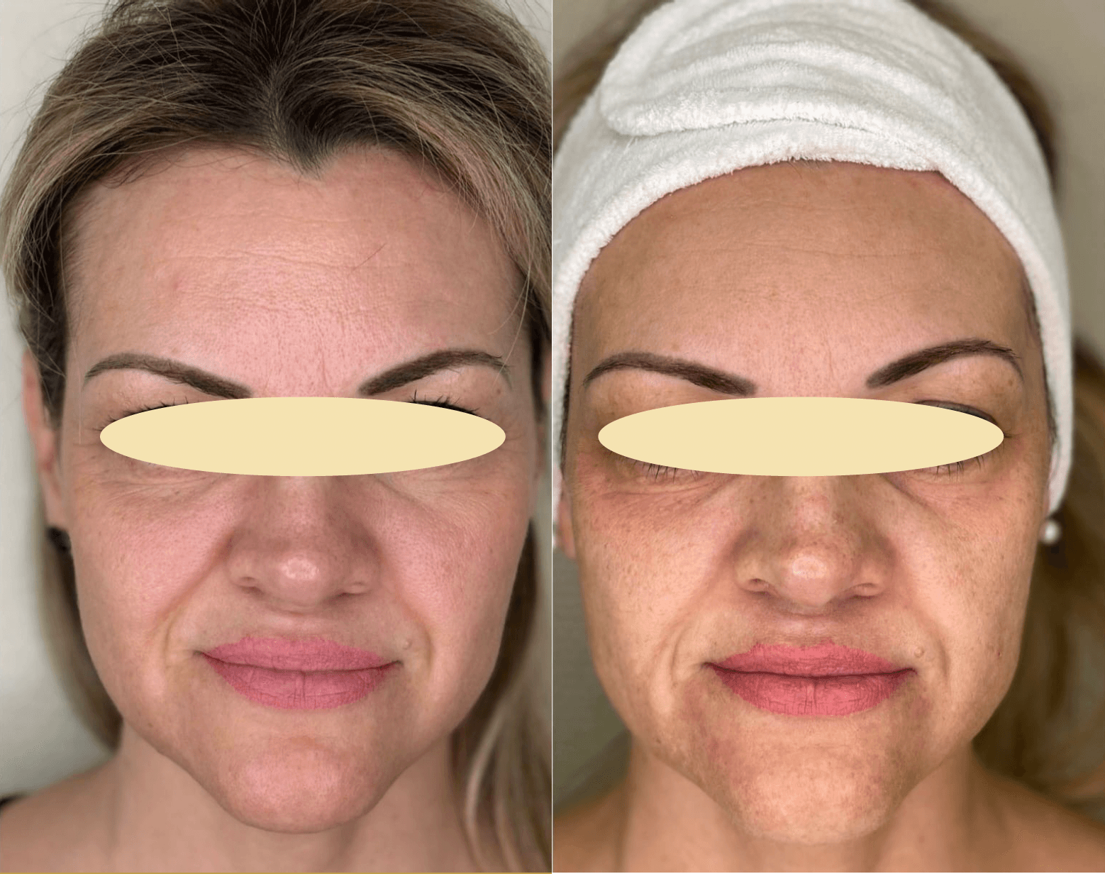 Example of Exosomes effect